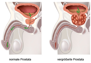 links: gesunde Prostata, rechts: vergrößerte Prostata